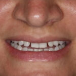 Diastema