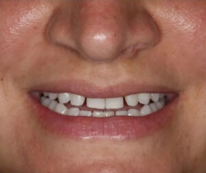 Diastema