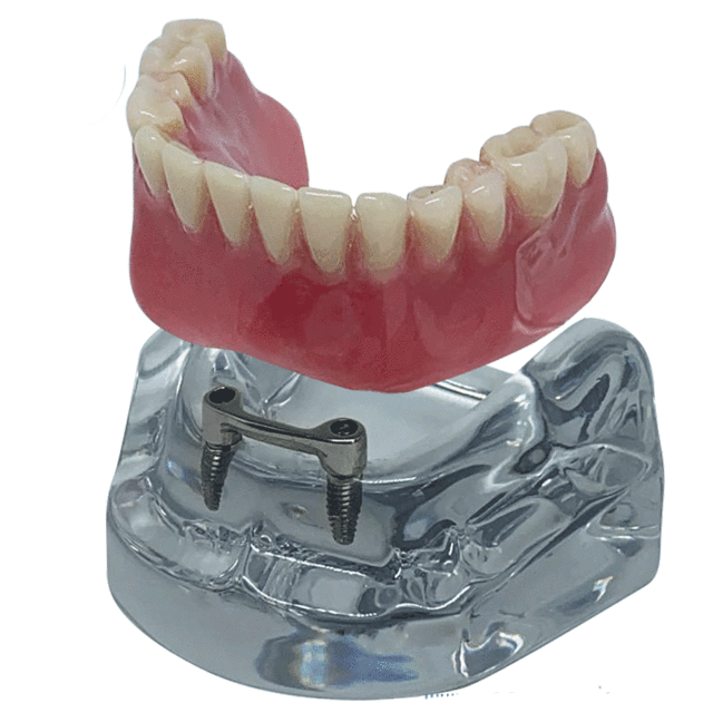 Implantes com prótese overdenture
