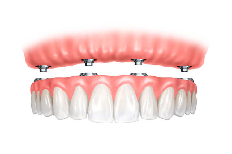 Implantes com protocolo